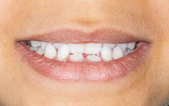 Frontal view of a young girl with a skeletal Class III malocclusion biting teeth lips open. Milk teeth and permanent incisors, anterior crossbite because of retruded maxilla or protruded mandible