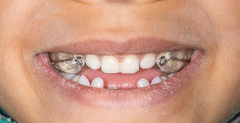 Frontal view of a young dental patient case smiling. Palatal expander device sealed to widen the upper jaw in orthodontics treatment. Transparent acrylic resin with metal hooks.  © MSC