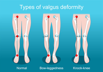 valgus deformities. Knee deformity. Corrective surgery