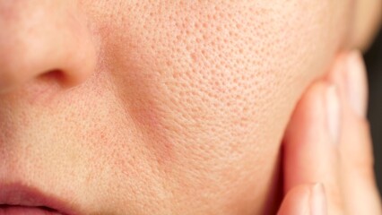 Close-up of part of the face. facial skin with enlarged pores, problem skin. Cosmetology. texture...