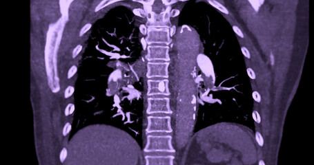 A CTA pulmonary artery reveals a detailed view of the lung blood vessels, capturing the presence of a pulmonary embolism, a condition where a blood clot disrupts normal blood flow.