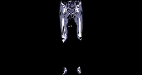 A CT venogram of the leg is a non-invasive imaging procedure offering detailed visuals of leg veins.