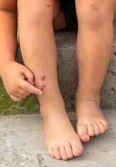 A child has a scratch on his leg. Selective focus.