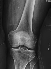 An x ray of a knee joint.