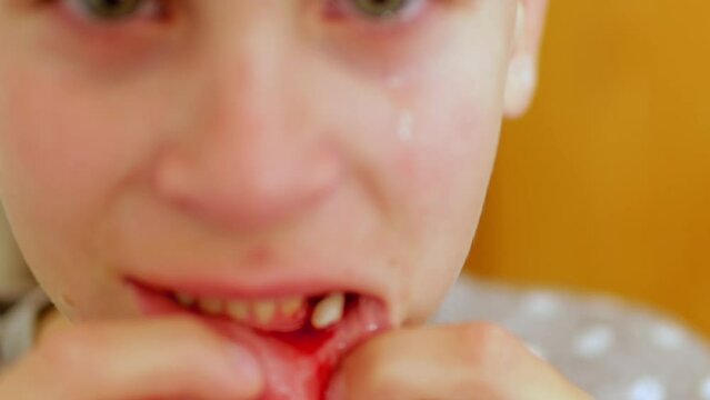 The boy is crying, experiencing a little pain after his front baby tooth was pulled out. 