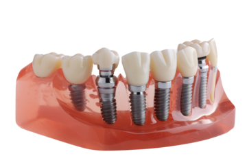 dental model featuring multiple implants, demonstrating various tooth replacement options.