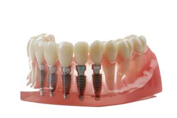 dental model featuring multiple implants, demonstrating various tooth replacement options.