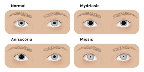Realistic human normal eyes and with mydriasis, anisocoria, miosis