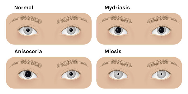 Realistic human normal eyes and with mydriasis, anisocoria, miosis