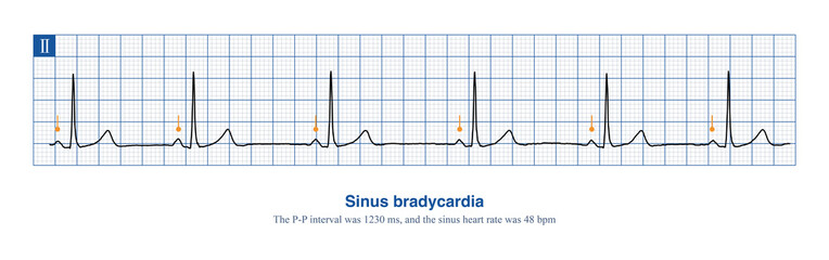 When the frequency of sinus rhythm is less than 60 beats per minute, it is called sinus bradycardia. Severe sinus bradycardia should be suspicious of sick sinus syndrome.