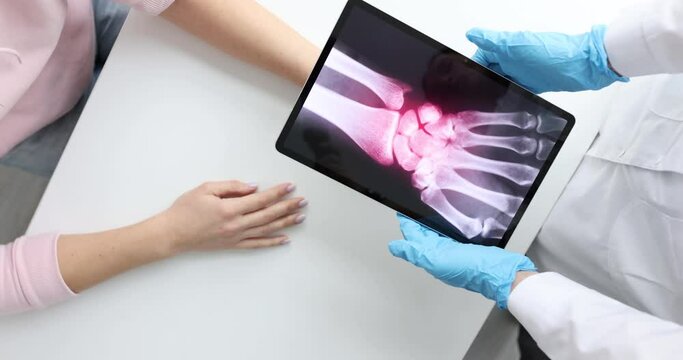Inflammation of bones of hand on x-ray of patient. Hand sprains concept