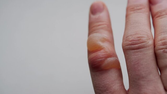 a burn with a blister on a man's finger. White background. First degree burn. Treatment of burns, close-up. Redness on the skin from a burn