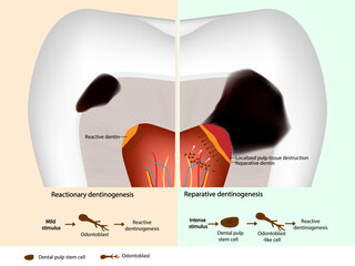 Schematic diagram of tertiary dentin formation. Reparative dentinogenesis and Reactive dentinogenesis. Odontoblast and Dental pulp stem cell © sakurra