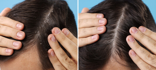 Fototapeta premium Man showing hair before and after dandruff treatment on light blue background, collage