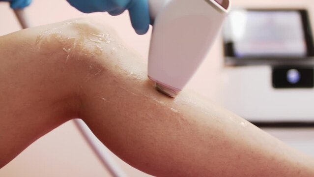 Laser hair removal on legs. Getting rid of unwanted body hair, body care, removal of unwanted hair, cosmetology. Beautiful female legs.
