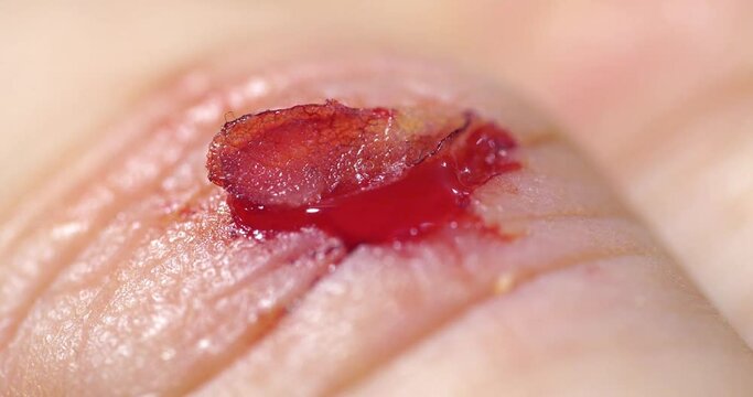 Injury to middle finger of right hand with bleeding. Flayed skin, red blood and lymphatic fluid flows from the wound. Cinema 4K 60fps macro shot zoom-out video