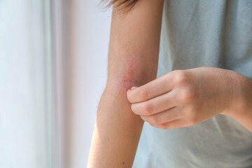 a girl scratches the skin on the elbow of her arm, redness is atopic dermatitis, the girl s face is not visible