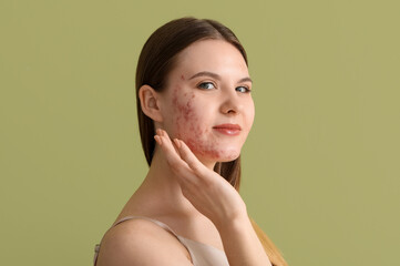 Young woman with acne problem on green background, closeup