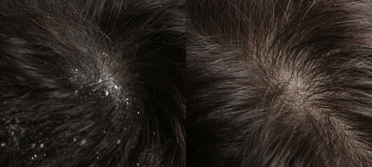 Man showing hair before and after dandruff treatment, collage