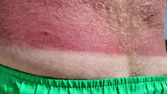 Close-up view of a sunburn on human skin, depicting pain and the importance of sun protection during the summer season