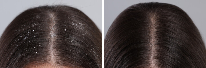 Woman showing hair before and after dandruff treatment on grey background, collage