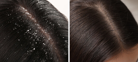 Woman showing hair before and after dandruff treatment, collage