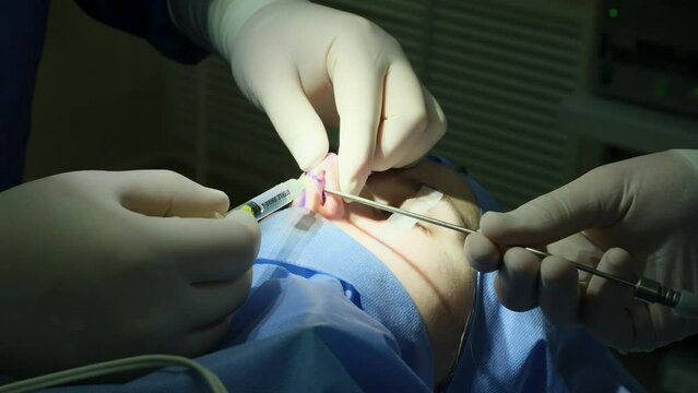 Local anesthesia of the nose with a styrene syringe to a girl patient. Endoscopic septoplasty surgery. Close-up.