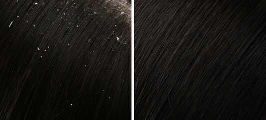 Woman showing hair before and after dandruff treatment, collage