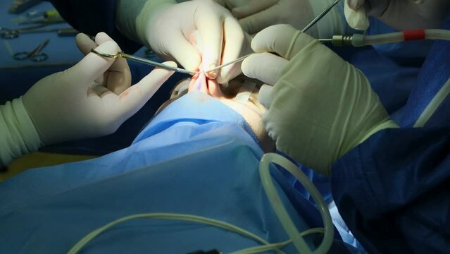 A group of doctors perform rhinoplasty or endoscopic septoplasty on a young girl. Close-up.