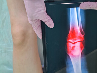 Traumatologist examines x-ray of little girl leg and inflammation of knee