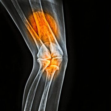 Osteoarthritis Left knee film x-ray AP (anterior - posterior) of knee show narrow joint space