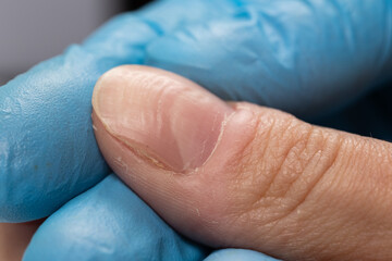 Doctor examining a ridged fingernails with vertical and horizontal ridges. Nails problems