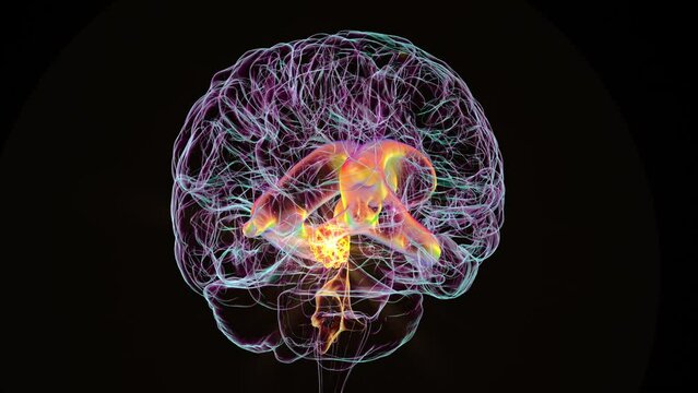 A 3D scientific animation depicting enlarged lateral and third ventricles of the brain (hydrocephalus), caused by a brain tumor compressing the cerebral aqueduct.