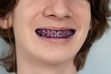 Plaque indicator on human teeth with braces. Plaque is colored pink. Teenager using plaque...