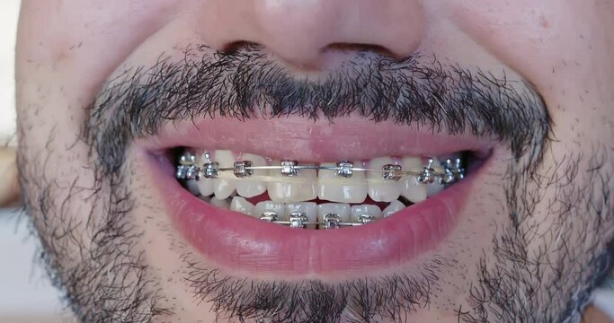Close-up of a metal bracket system on white, even teeth. Braces for bearded man