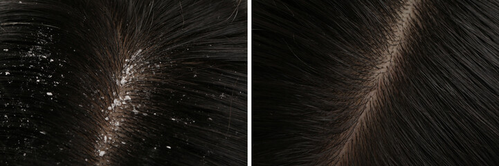 Woman showing hair before and after dandruff treatment, collage