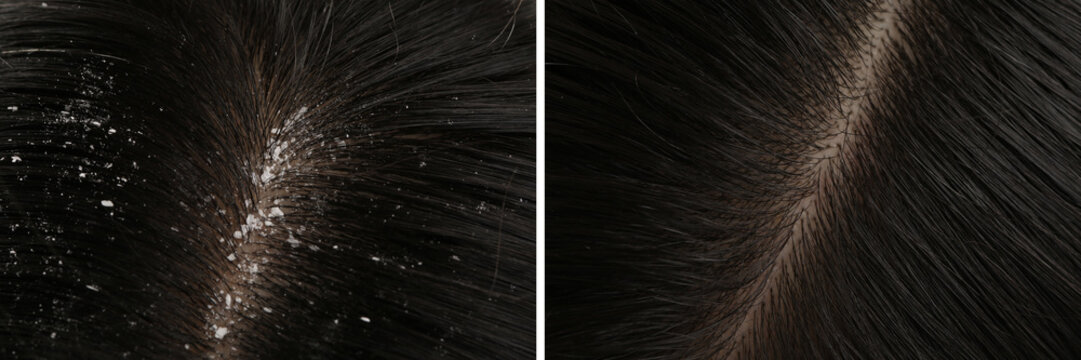 Woman showing hair before and after dandruff treatment, collage