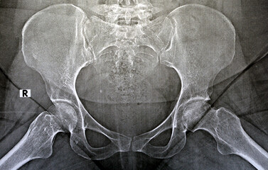 Plain X ray reveals bilateral Avascular necrosis (AVN) of the femoral head more in the left side, a...