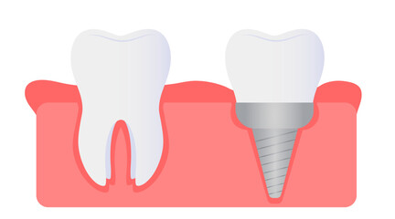 Natural and implanted teeth in gum on white background