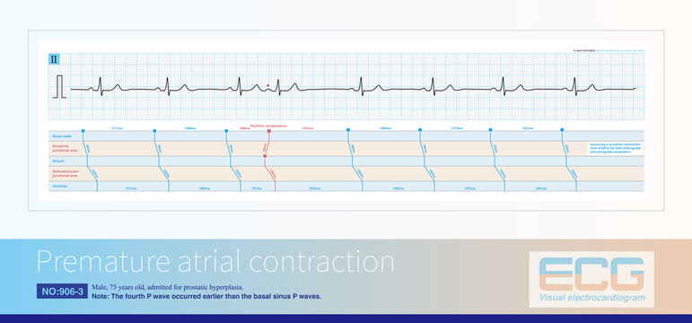 The ECG diagnosis of atrial premature contraction is an early P wave with a morphology that differs from sinus P wave and is mostly incomplete in compensatory intervals.