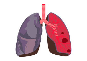 肺がんの肺の内部