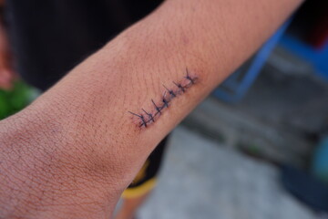 scars that have been stitched after surgery on the arm