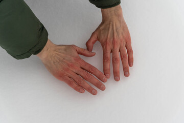 Man's hands turned red in snow: portrayal of resilience and immunity in winter