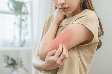 Obraz na płótnie Canvas Dermatology asian young woman, girl allergy, allergic reaction from atopic, insect bites on her arm, hand in scratching itchy, itch red spot or rash of skin. Healthcare, treatment of beauty.