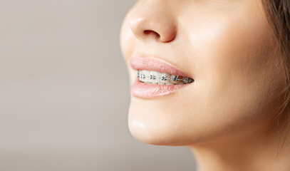 Closeup Metal Brackets on Teeth. Orthodontic Dental. Woman Healthy Smile. Female Smile with Braces. Close up of white teeth with braces. Dental care and treatment. Girl smile with Braces accessories