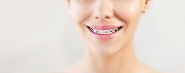 Closeup Metal Brackets on Teeth. Orthodontic Dental. Woman Healthy Smile. Female Smile with Braces. Close up of white teeth with braces. Dental care and treatment. Girl smile with Braces accessories