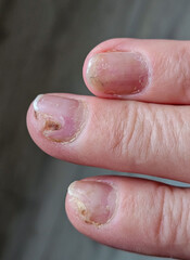 Hands and fingers with psoriatic onychodystrophy or psoriatic nails. fungal infection of nails. Deformed human nails. Damaged yellow human nail. Burn to the nail plate after a poor-quality manicure