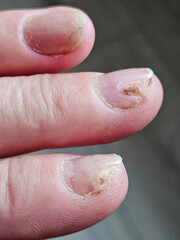 Hands and fingers with psoriatic onychodystrophy or psoriatic nails. fungal infection of nails....