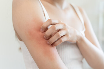 Fototapeta na wymiar Sensitive skin allergic concept, Woman itching on her arm have a red rash from allergy symptom and from scratching.