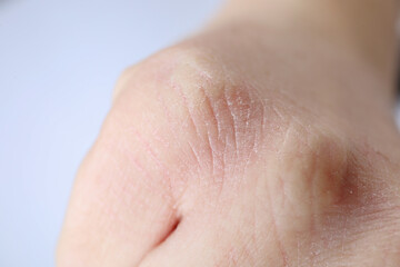 Woman with dry skin on hand against light background, closeup